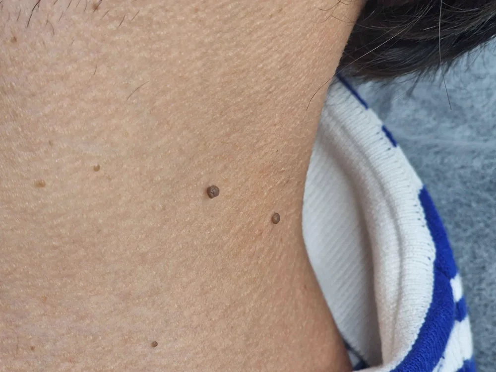 Neck photograph from WOB’s skin-tag treatment gallery