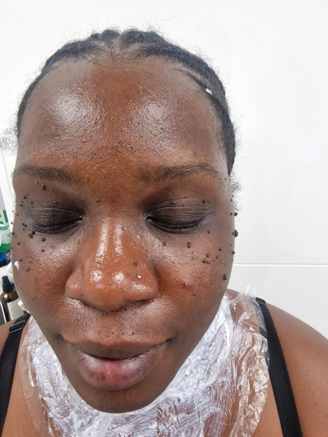 DPN case 03: photograph labelled before treatment