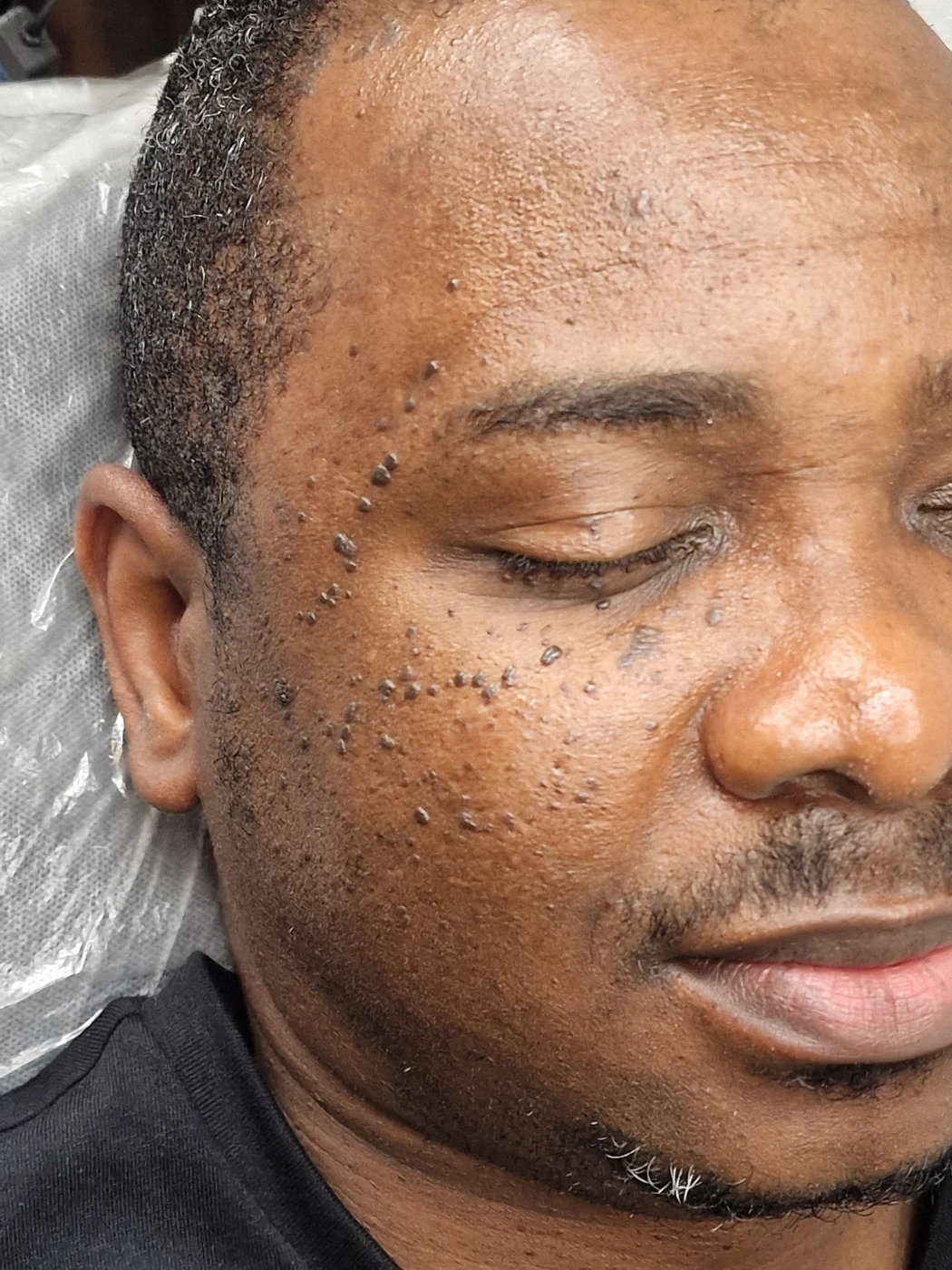 DPN case 04: photograph labelled before treatment
