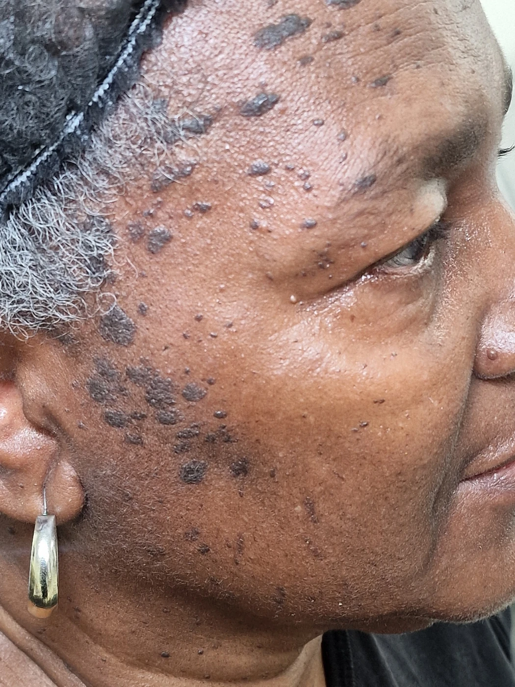 Seborrhoeic keratosis case 01: before treatment