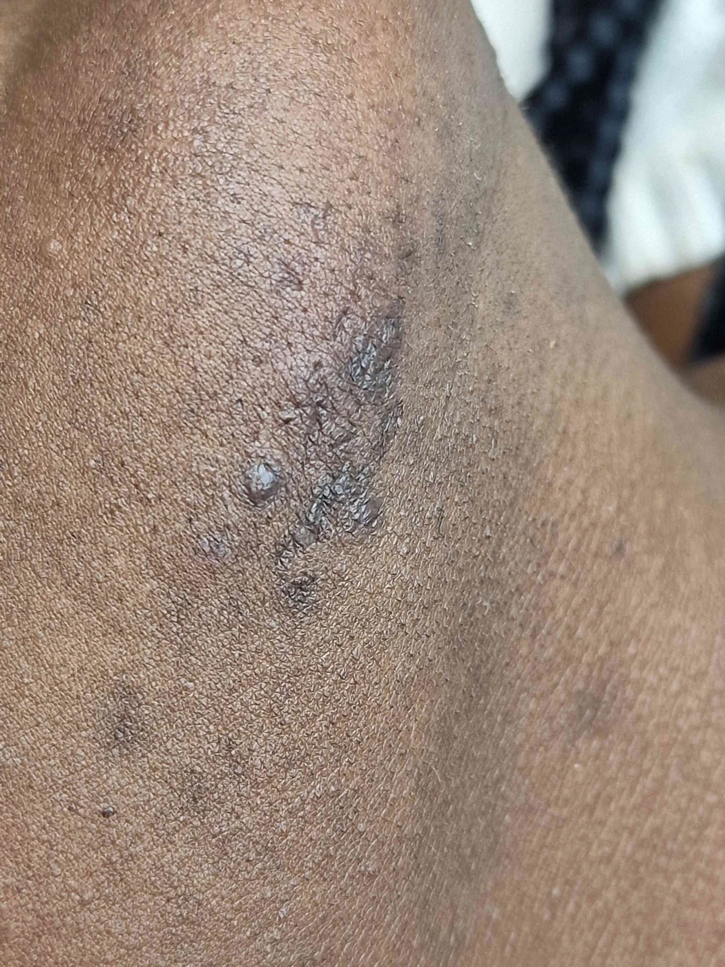 Electrolysis progress photograph from WOB’s hair-removal page