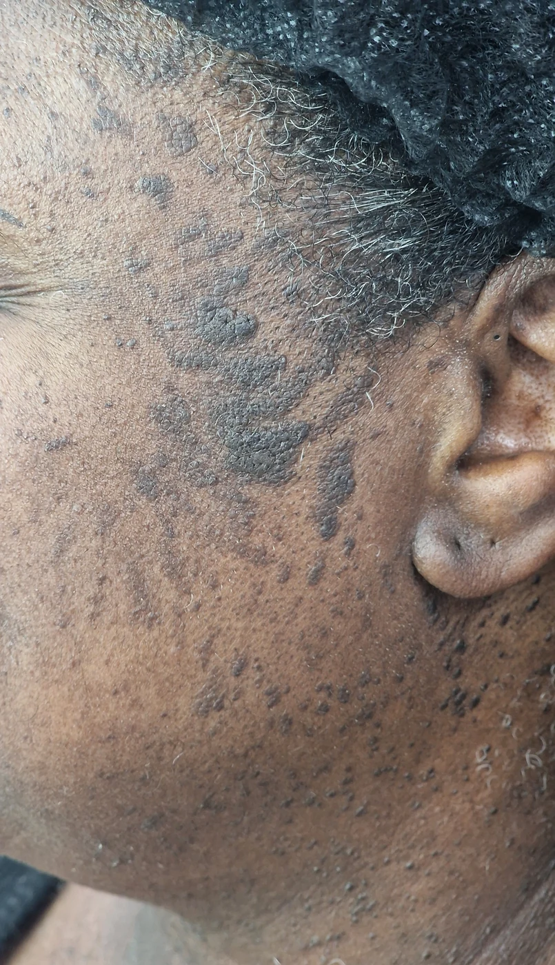 Individual photograph supplied in the seborrhoeic keratosis folder
