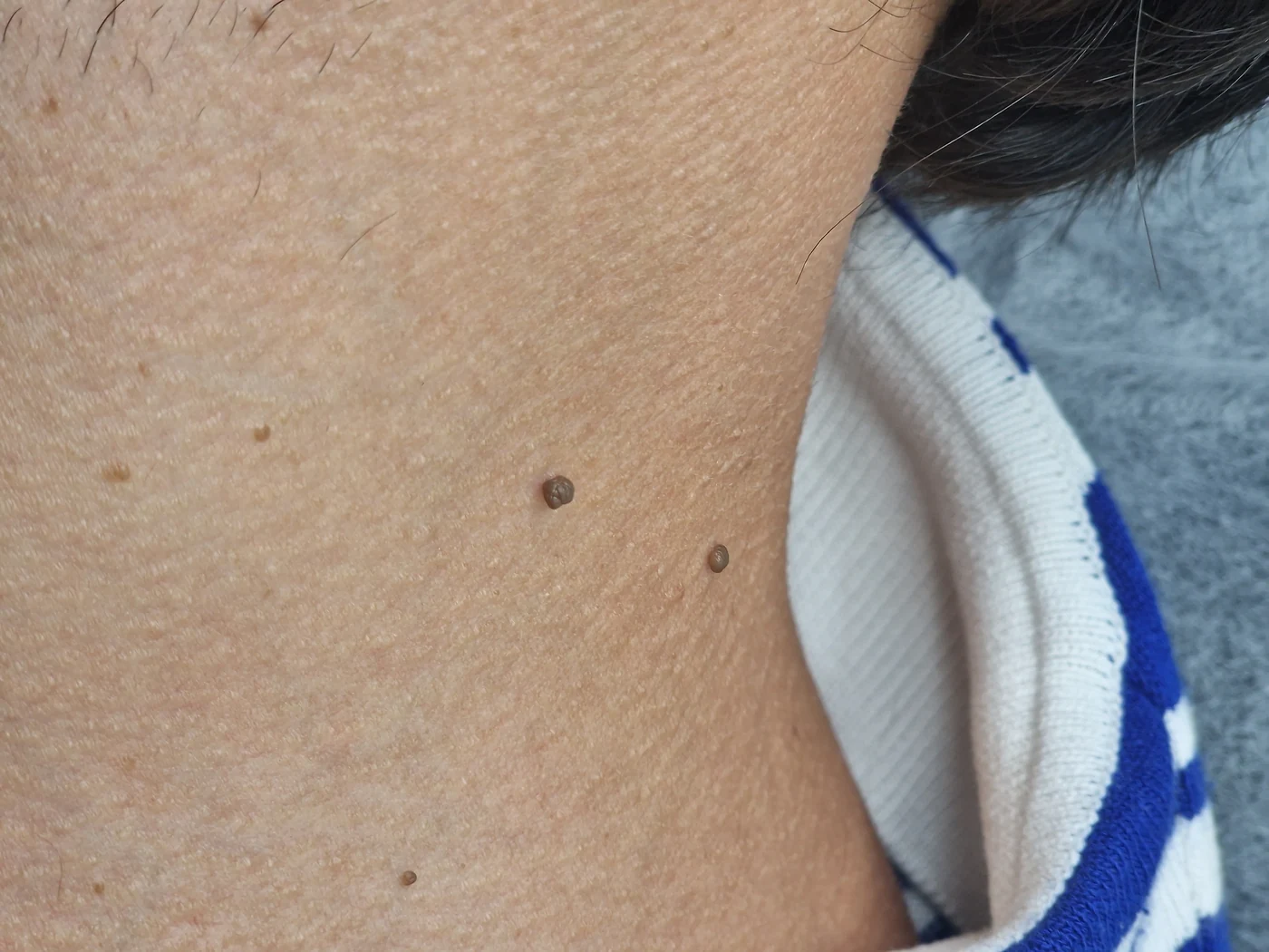 Neck photograph supplied for the skin-tag removal page